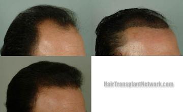 Hair transplantation surgery before and after images