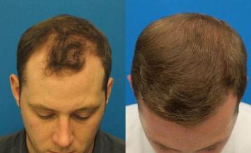 Hair restoration surgery before and after images