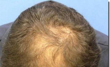 Hair restoration procedure results