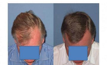 Top view of hair restoration procedure