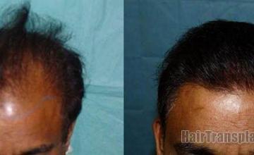 View from the top showing hair transplant results