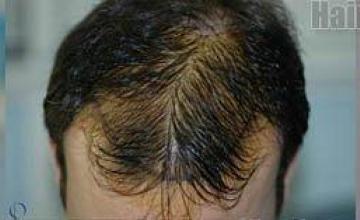 Pictures showing before and after hair transplant results