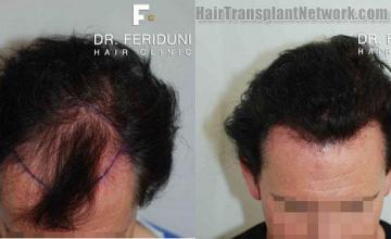 Hair restoration procedure before and after pictures