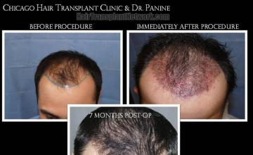 Hair transplantation surgery before and after photos