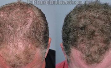 Hair transplantation surgery before and after photos