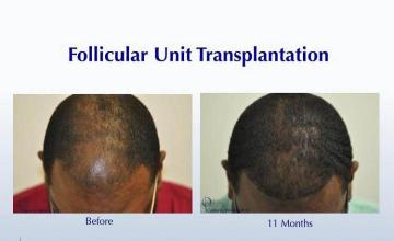 Hair transplantation surgery before and after photos