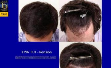 Hair transplantation surgery before and after photos