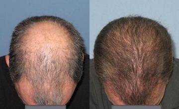 Hair transplantation surgery before and after photos