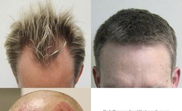 Hair transplantation surgery before and after photos