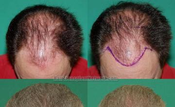 Hair transplantation surgery before and after photos