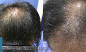 Top view before and after hair restoration results