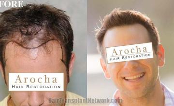 Hair transplantation surgery before and after photos