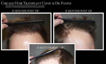 Hair restoration surgery before and after photos