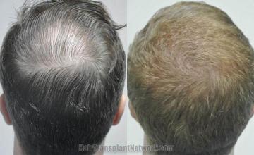 Hair transplantation surgery before and after pictures