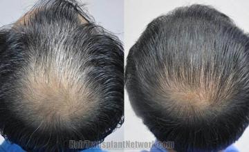 Hair restoration procedure before and after pictures