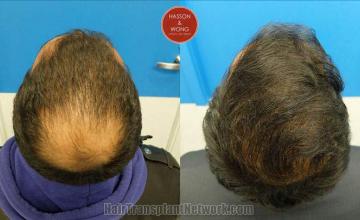 Hair restoration procedure before and after pictures