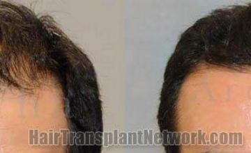 Hair restoration before and after photos