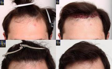 Before and after hair transplant procedure images