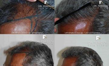 Left view before and after hair restoration procedure