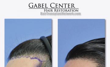 Hair transplantation surgery before and after photos