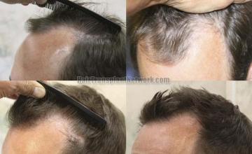 Hair transplantation surgery before and after images