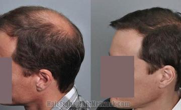 Hair transplantation surgery before and after photos