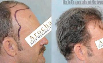 Hair transplantation surgery before and after photos