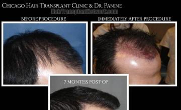 Hair transplantation surgery before and after images