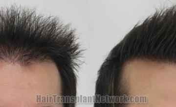 Hair restoration procedure before and after pictures