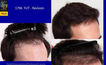 Hair transplantation surgery before and after images