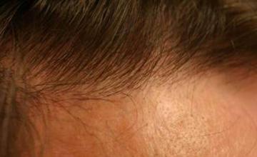 Hair restoration procedure results