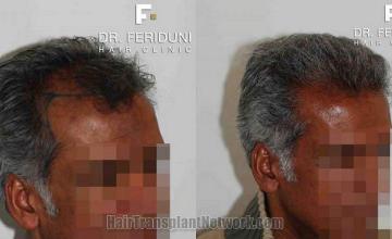 Hair transplant surgery results photos right oblique view