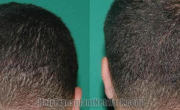 Back view before and after hair transplantation photos