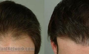 Hair transplantation surgery before and after images