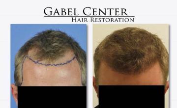 Hair restoration procedure before and after pictures