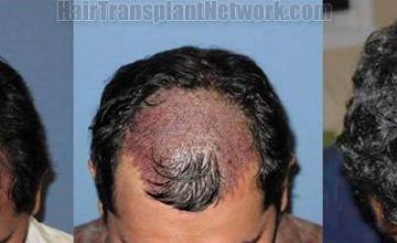 Hair restoration before and after pictures - Top view