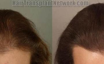 Female hair restoration photo results