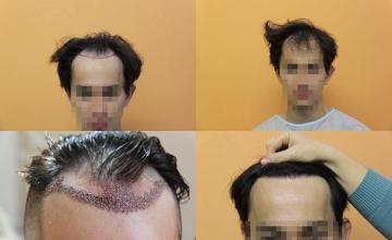 Hair restoration procedure before and after results