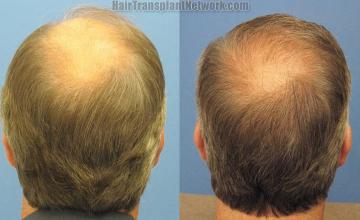 Back view before and after hair restoration procedure