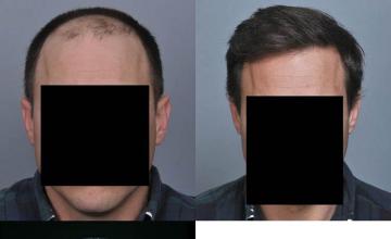 Hair transplantation surgery before and after pictures