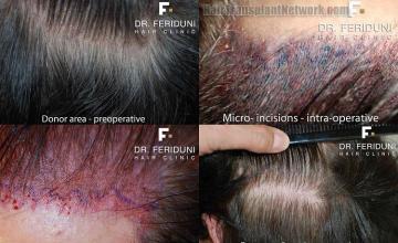 Intraoperative photos of hair restoration procedure