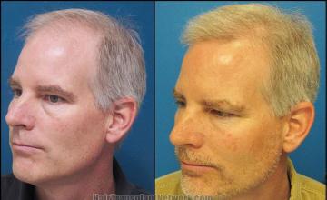 Hair restoration procedure before and after pictures