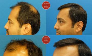 Hair transplantation surgery before and after pictures