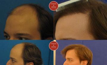 Hair transplantation surgery before and after images