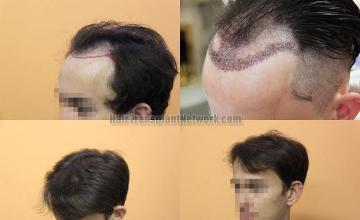 Hair transplantation surgery before and after pictures