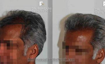 Hair transplant surgery results images left oblique view