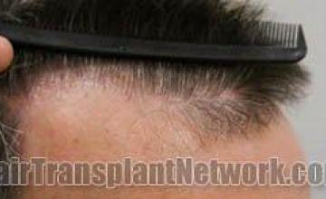 Right view - Hair restoration photos