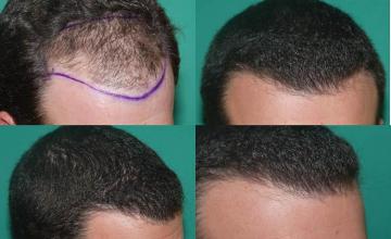 Before and after hair transplant procedure images