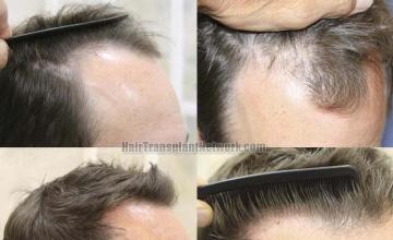 Hair transplantation surgery before and after photos