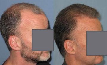 Hair transplantation surgery before and after images